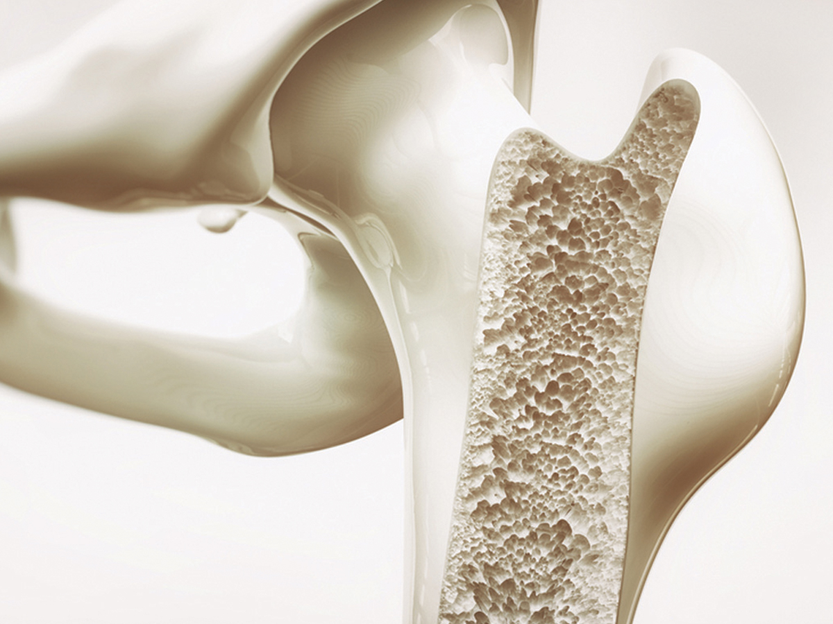 Osteoporoz (Kemik erimesi)